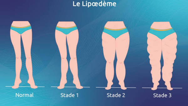 Lipœdème : une maladie encore méconnue au Maroc, la voie de la prise en charge en Espagne